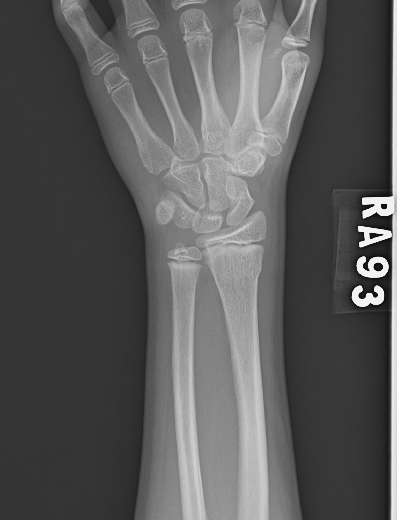 Detección de fracturas IA