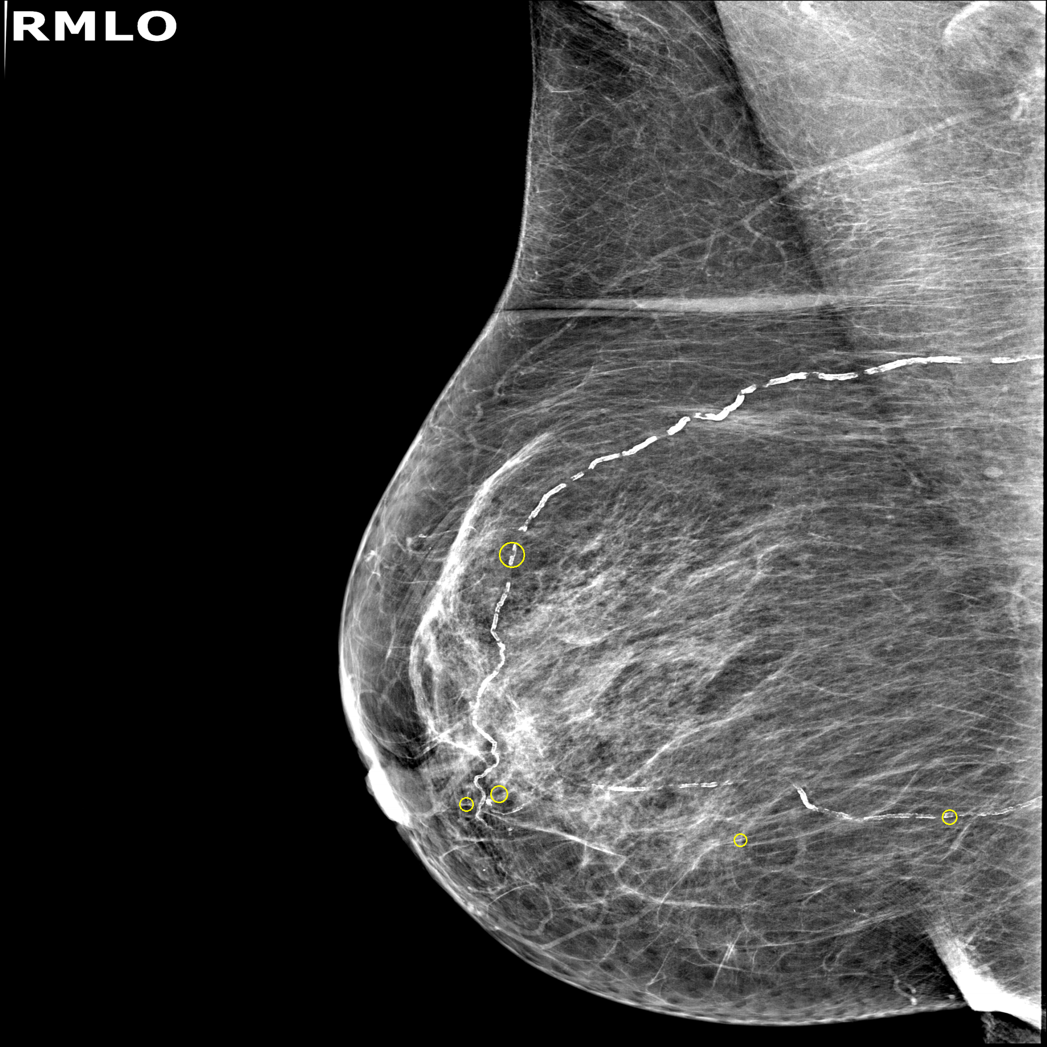 Sistema IA Mamografías
